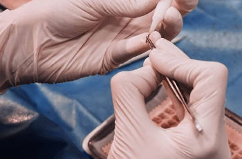 Close-up of a surgeon performing a beard transplant using the DHI implanter pen for accurate angle, depth, and direction.