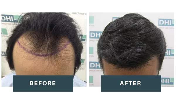 BEFORE AFTER REUSLT DHI MALAYSIA Hair transplant safety standards in Malaysia clinic