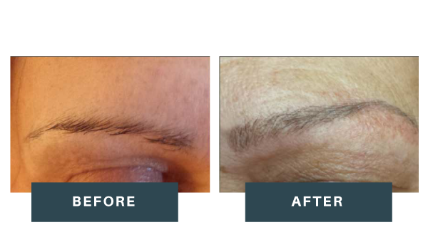 Patient after eyebrow transplant at DHI Malaysia, showing fuller, natural-looking brows designed to match facial symmetry.