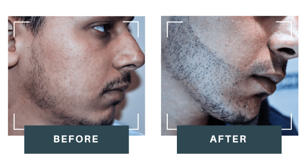 ide-by-side comparison showing a male patient’s face before and after beard transplant at DHI Malaysia with fuller, natural beard density.