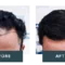 The Effects of Implantation Angle on the Outcome of Hair Transplant Surgery