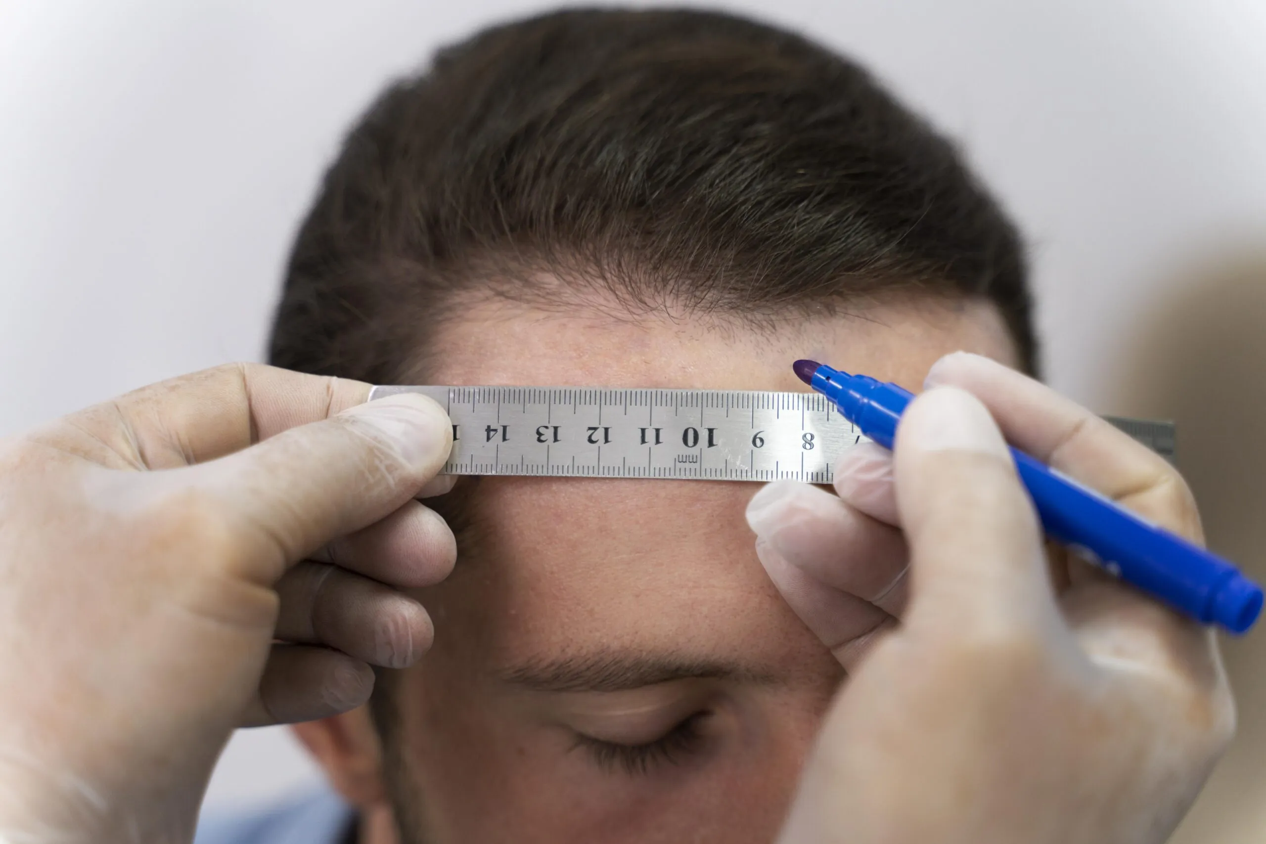 Initial signs of a receding hairline, a common indicator of early male hair loss