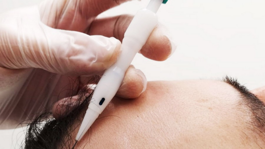 Natural hairline achieved with DHI technique at the best hair transplant clinic in Malaysia