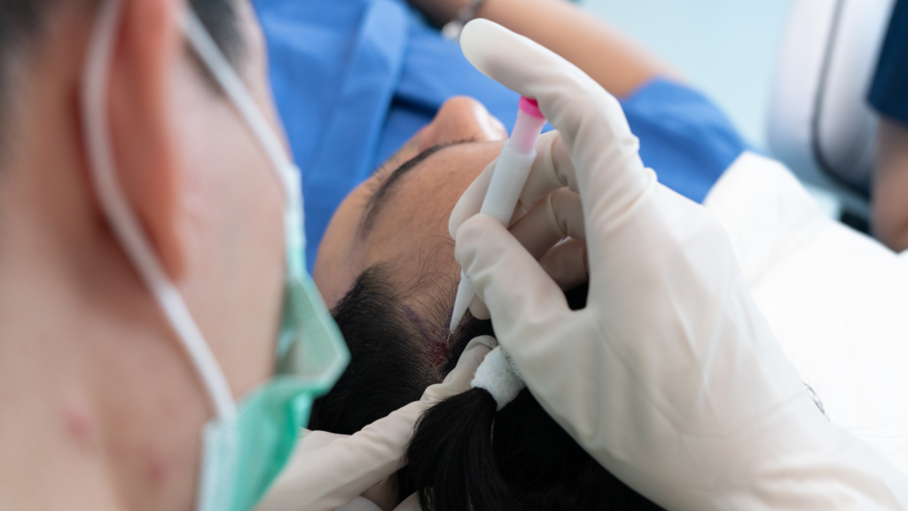 Doctor performing a DHI hair transplant at the best hair transplant clinic in Malaysia Best hair transplant clinic in Malaysia doctor performing DHI procedure