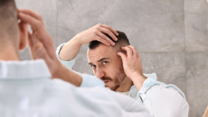 Natural hair transplant result with soft hairline and proper density
