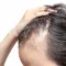 Graft Failure vs. Shock Loss After Hair Transplant