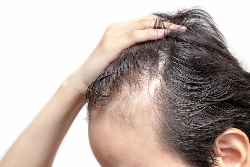 Patient experiencing temporary shock loss after a hair transplant during the normal healing process. Shock Loss After Hair Transplant Recovery