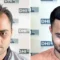 How DHI Malaysia Creates Natural Hair Transplant Results