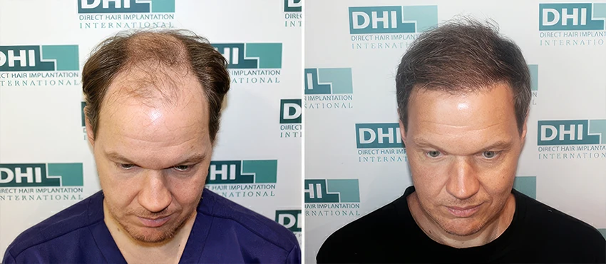 Permanent Hair Transplant Results That Age Naturally