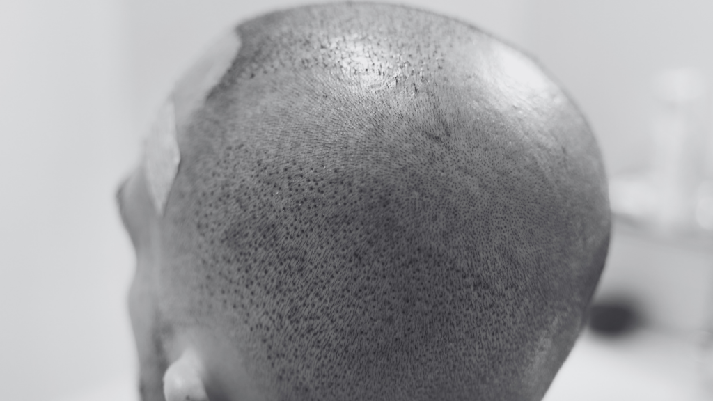 Hair Transplant Aftercare at DHI Malaysia