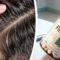 Do You Really Need Finasteride After Your Hair Transplant?